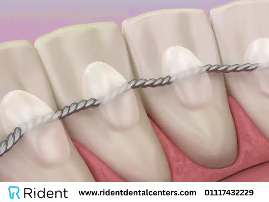 الفرق بين مثبت التقويم الشفاف والحديد، أيهما تختار بعد إزالة التقويم؟